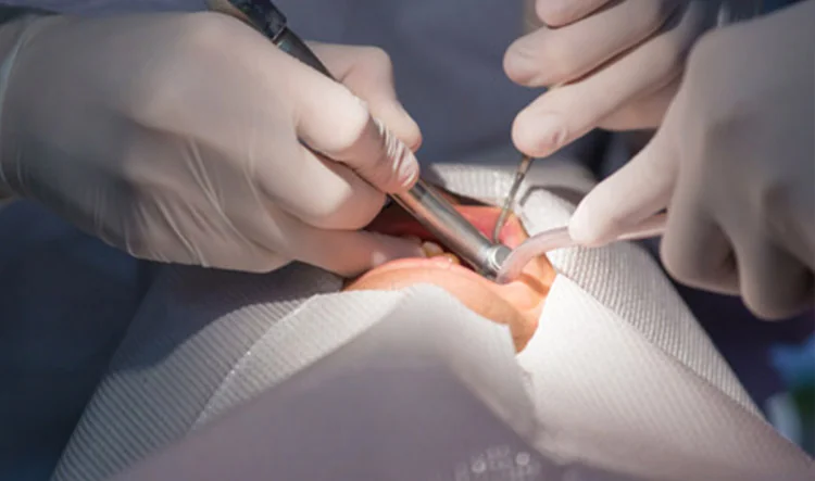 Cirurgia Bucomaxilofacial e Sisos