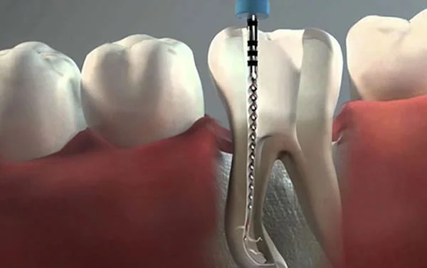 Endodontia e Tratamento de Canal